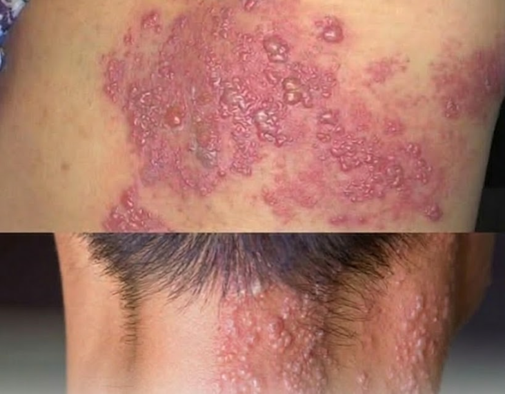 Das sind die Folgen, wenn man mit der falschen Person schläft – Ärzte warnen Männer vor diesem Virus - BuzzDay